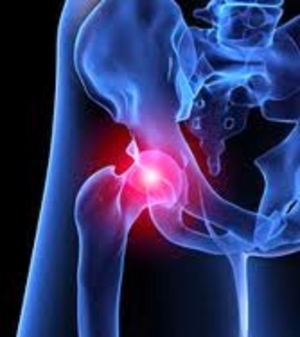 DePuy%20ASR%20Metallosis%20Injury%20Attorney.jpg