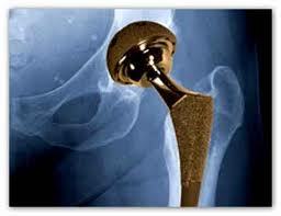 metal%20on%20metal%20hip%20injury%20attorney.jpg