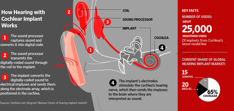 Cochlear_Implant_Failure_Attorney.jpg
