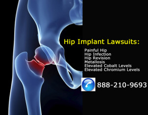 Metal Hip Implant Failure Lawsuits