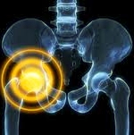 Defective metal hip and hip replacement