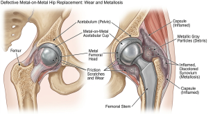 defective-metal-on-metal-hip-implant-showing- severe-friction-wear-surface-scratches-and- microscopic-cobalt-chromium-debris-release-causing-metallosis